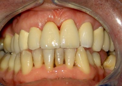 Kompresija zuba i protetsko zbrinjavanje