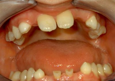 Implanto protetsko zbrinjavanje hipodoncije