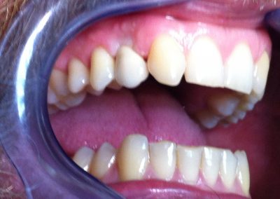 Implanto protetsko zbrinjavanje nedostatka jednog zuba