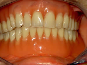 Implanto protetsko zbrinjavanje sa mini implantatima